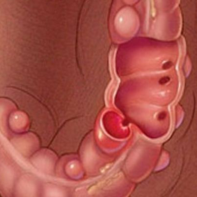 Εκκολπωματική Νόσος